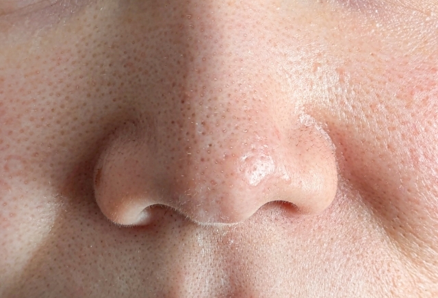 毛穴からニョロニョロ